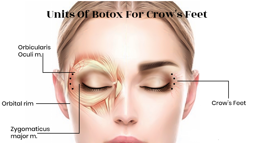 Botulinum Toxin crows feet